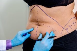 Transformação Pós-Cesárea: lipo HD
