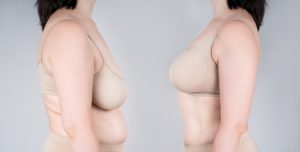 Mamoplastia Após Amamentação