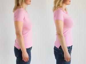 Como é a recuperação de quem faz lipo e mastopexia com prótes