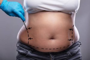 Abdominoplastia: histórias de sucesso de pacientes reais
