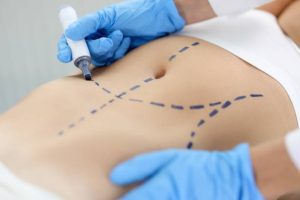 Cirurgia plástica: desmistificando os principais mitos