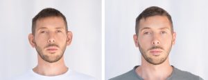 Qual a melhor idade para fazer otoplastia