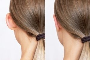 Tudo Sobre Otoplastia: Necessidade, Procedimento e Alternativas