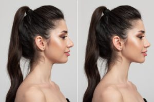 Como funciona uma Rinoplastia em BH