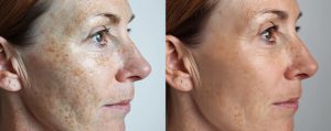 Tratamento Sculptra®: estimula a produção de colágeno para uma pele melhor e mais lisa