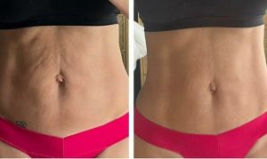 BodyTite 1