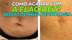 BodyTite: Quais os Benefícios e Resultados do BodyTite?