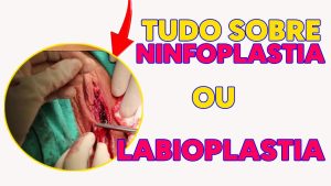 Ninfoplastia: O que é e como funciona essa cirurgia íntima?