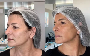 morpheus 8 rosto antes e depois